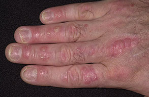 The hand in psoriasis.