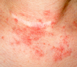 eczema, skin symptoms you are dealing with very itchy patches of skin 