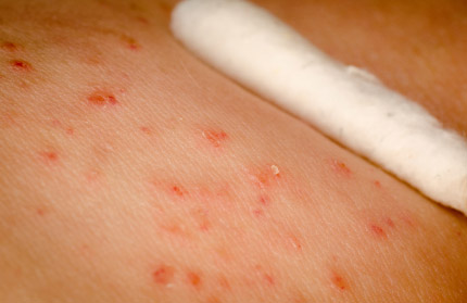 rashes that are contagious
