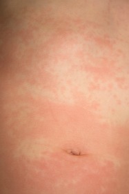 Hives Urticaria - What Does Hives Look Like?