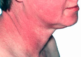 sudden face rash