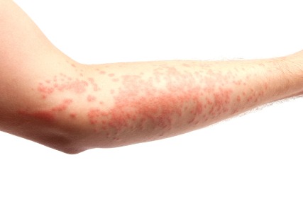 10 Signs That You Have The Hives - RM Healthy