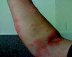 Food Allergy Rash