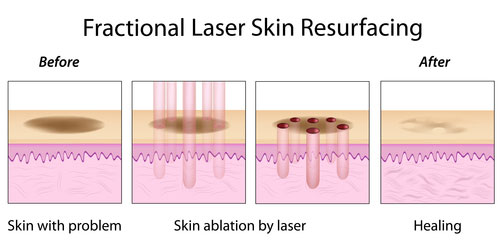 acne laser treatments