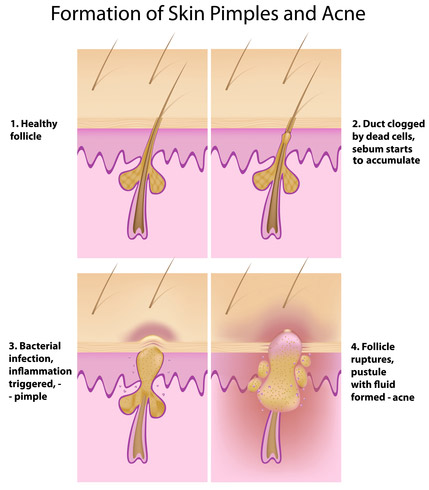 Cystic Acne Home Remedy