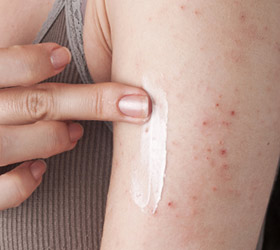 Treating Eczema Medically