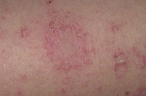 chronic eczema