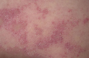 eczema chronic