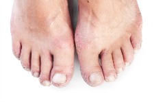 Picture of eczema rash on feet