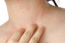 Photo of eczema rash on neck
