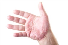 Photo of Hand Eczema