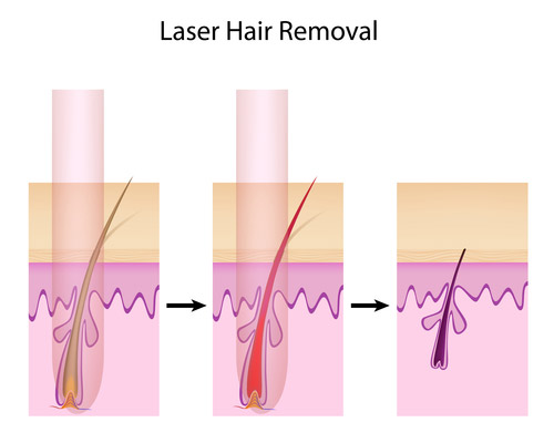 Why Use Home Laser Hair Removal?