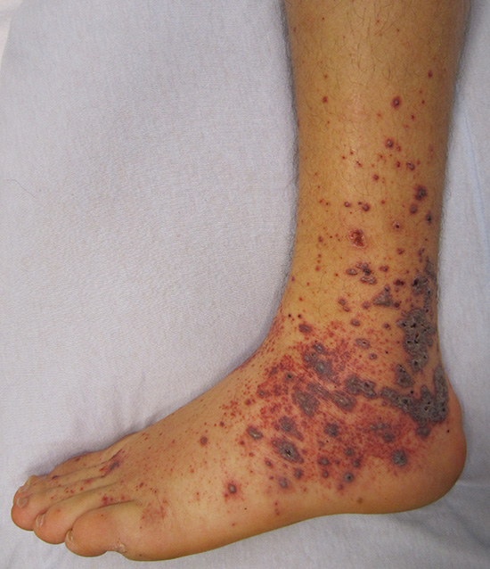 petechial rash