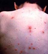 pictures of rashes