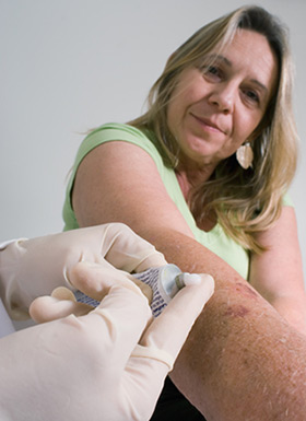 Clearing Sebhorreic Dermatitis