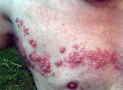 Shingles Rash