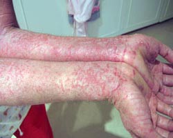 Dry Skin Rash