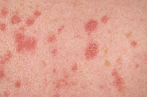 Psoriasis Guttate