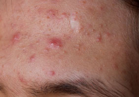 acne scar healing