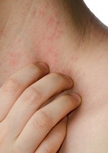 atopic dermatitis pictures