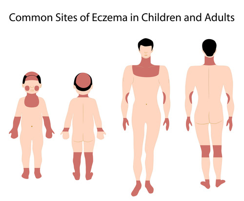 common sites of eczema in children and adults