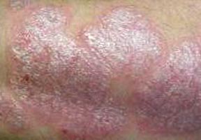 Dry Skin Rash