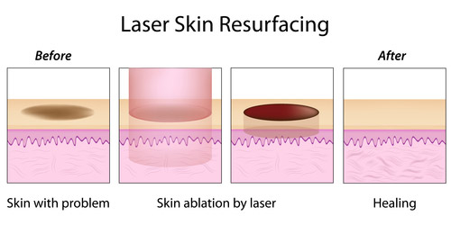Laser resurfacing