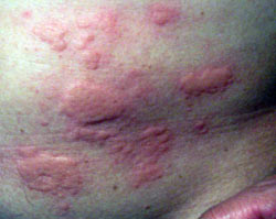 lupus body rash