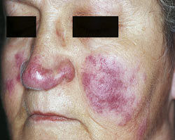 lupus face rash