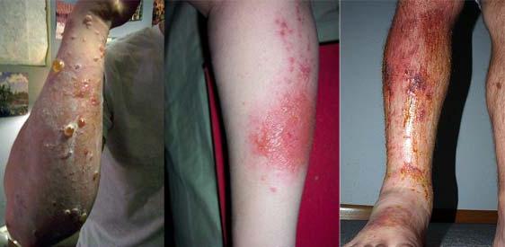 poison ivy rash picture