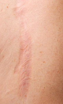 Stages of Scar Tissue Healing