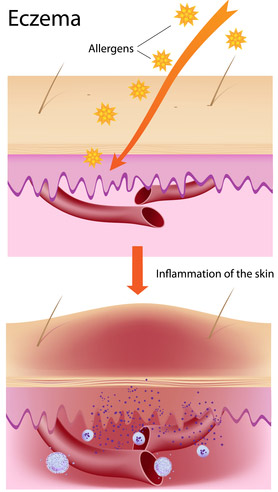 Causes of Eczema